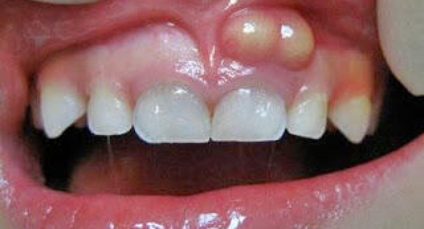 abses-gigi